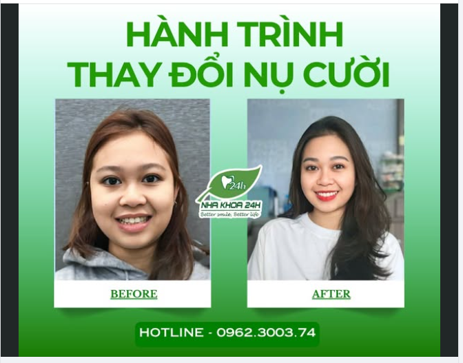 Hành trình thay đổi nụ cười đều đẹp – kết quả chuẩn chỉnh