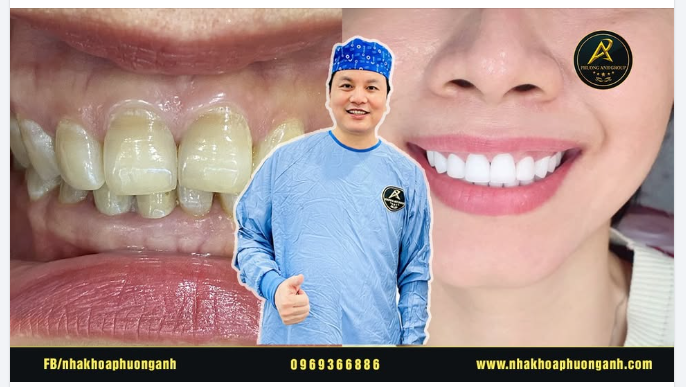Những lưu ý sau khi làm răng sứ thẩm mỹ