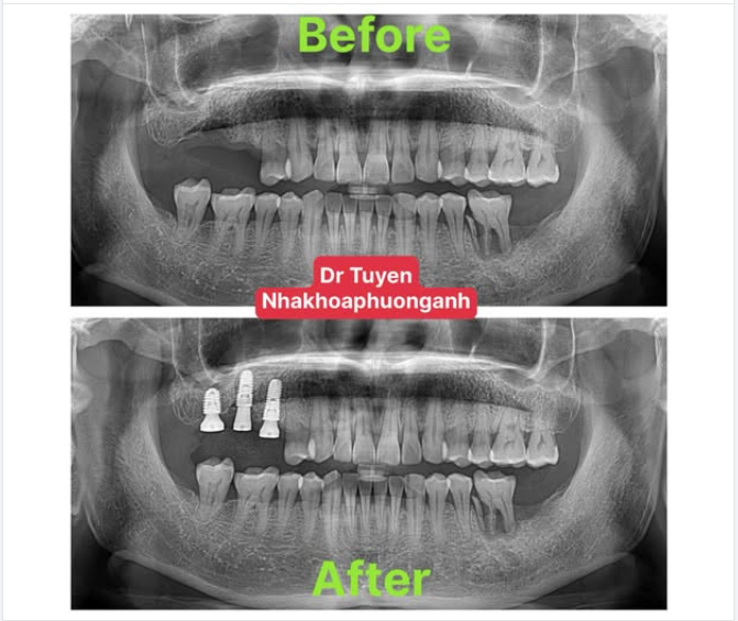 Tuổi Thọ Của Implant Răng: Những Điều Bạn Cần Biết
