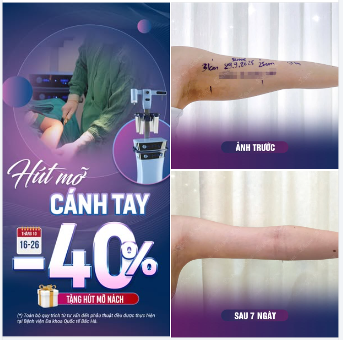 HÚT MỠ CÁNH TAY – GIẢM NGAY 40%