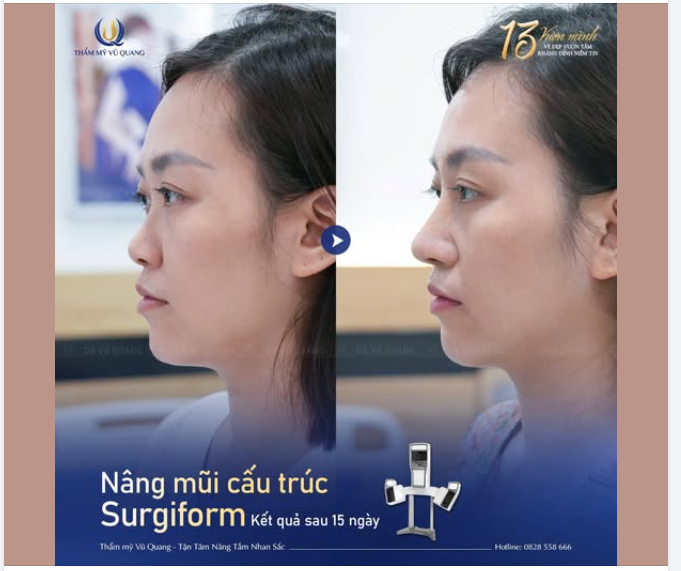 Đúng là chỉ khi được thực hiện bởi Bác sĩ chuyên môn cao, giàu kinh nghiệm như tại Thẩm mỹ Vũ Quang mới có được dáng mũi đúng ý như vậy!