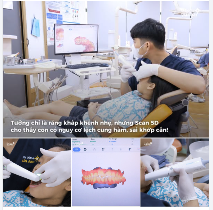 Tưởng chỉ là răng khấp khểnh nhẹ, nhưng Scan 5D cho thấy con có nguy cơ lệch cung hàm, sai khớp cắn