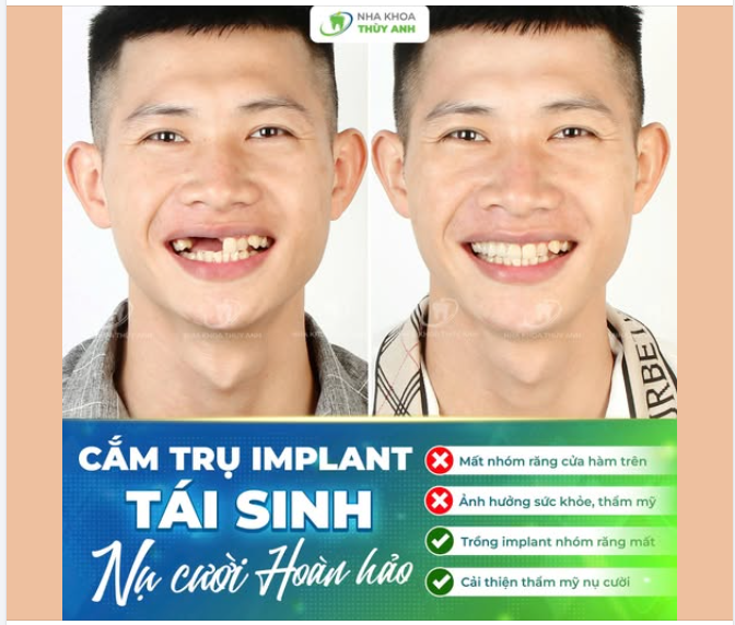 PHỤC HỒI NGAY NỤ CƯỜI TỰ TIN VỚI IMPLANT