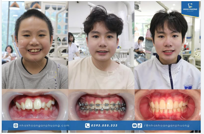 Hơn cả răng khỏe đẹp, đó là hành trang trưởng thành tuyệt vời cho Gia Hưng