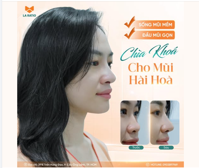 SỐNG MŨI MỀM – ĐẦU MŨI GỌN: CHÌA KHÓA CHO MŨI HÀI HÒA