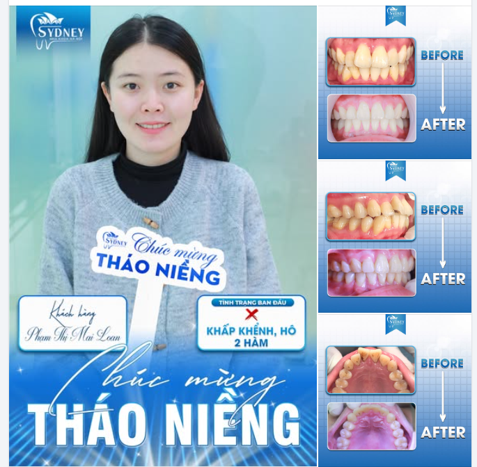 THÁO NIỀNG THÀNH CÔNG - KHOE NGAY NỤ CƯỜI ĐẸP CHUẨN TỈ LỆ