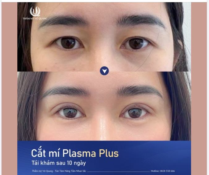 CẮT MÍ PLASMA PLUS - TÁI KHÁM SAU 10 NGÀY
