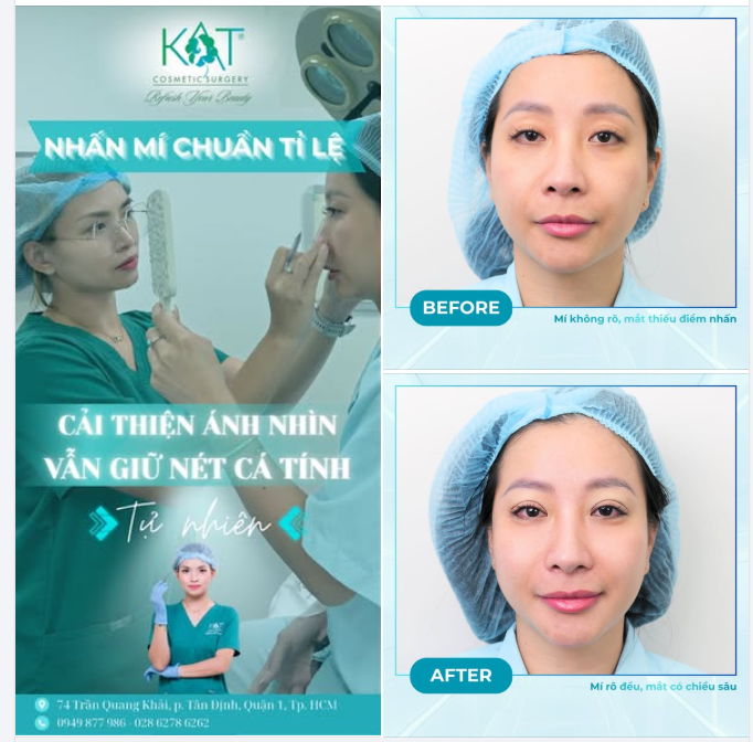 NHẤN MÍ CHUẨN TỈ LỆ – GIỮ TRỌN NÉT RIÊNG