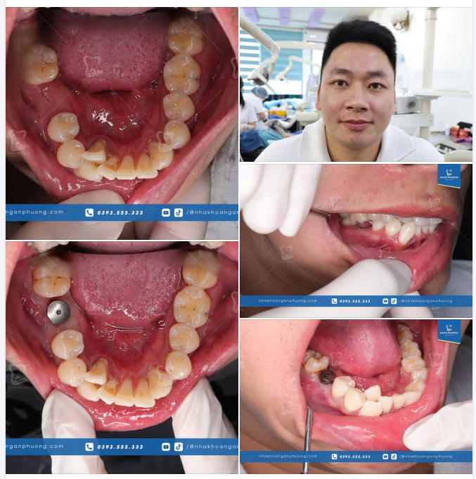 Phục hồi ăn nhai sau khi phục hình răng 6