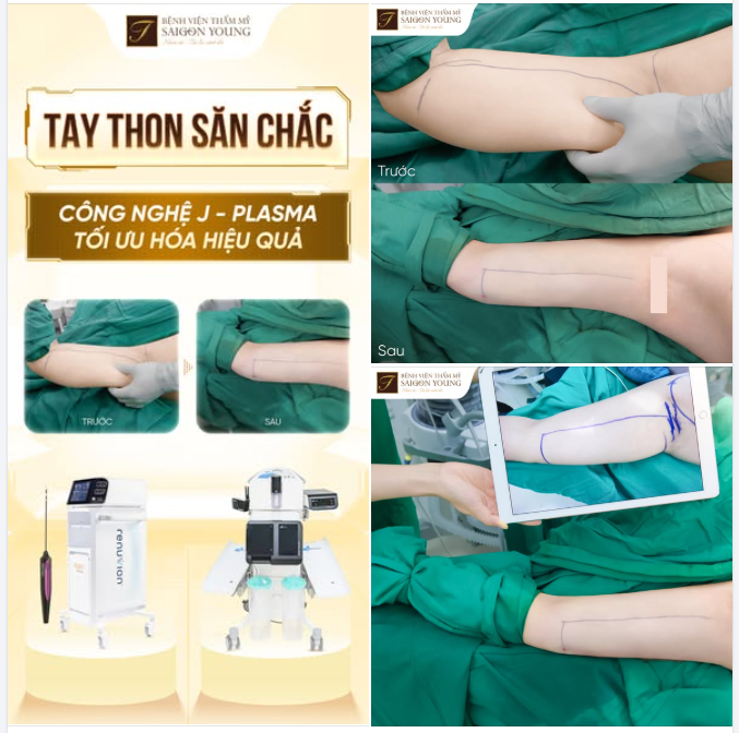 2 TRONG 1 - CÔNG NGHỆ J-PLASMA GIẢM MỠ KẾT HỢP SĂN CHẮC DA