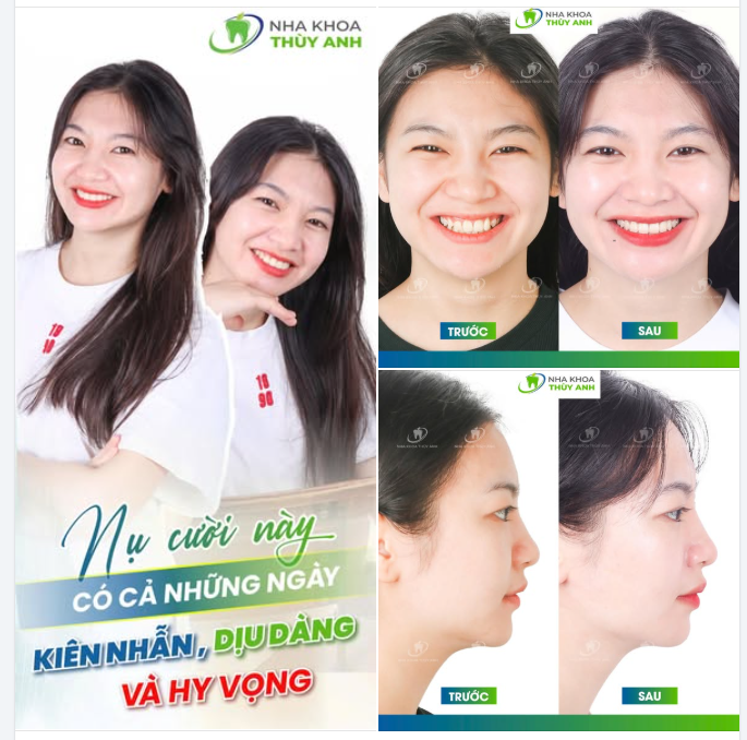 KHỚP CẮN CHUẨN ĐEM LẠI SỰ THAY ĐỔI LỚN TRONG THẨM MỸ VÀ CHỨC NĂNG ĂN NHAI