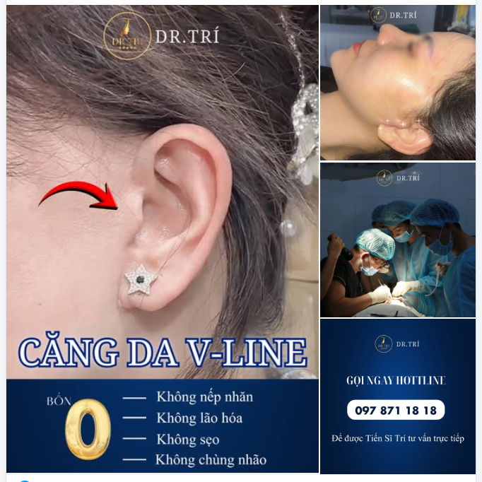 CĂNG DA V-LINE: BỐN KHÔNG HOÀN HẢO – CHẤP HẾT MỌI DẤU VẾT THỜI GIAN!