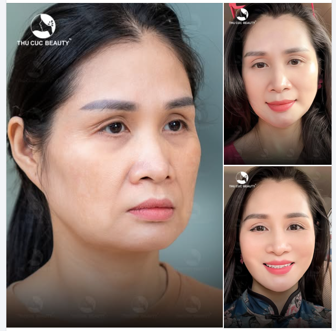 LiFU - Nâng cơ trẻ hóa chuẩn y khoa