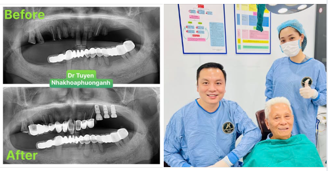 9 lợi ích của việc cấy ghép Implant