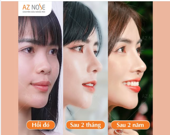 Dancer T.U. bùng nổ visual sau nâng mũi. Đặt lịch NGAY để nhận ưu đãi cuối năm!!