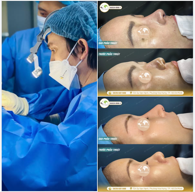 Trong tạo hình mũi, độ vững chắc của cấu trúc và sự tự nhiên của dáng mũi luôn là hai yếu tố được đặt lên hàng đầu.