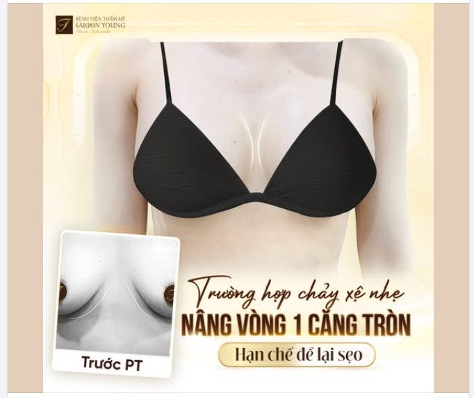 VÒNG 1 CĂNG TRÒN - ÍT THẤY SẸO Trường hợp chảy xệ nhẹ