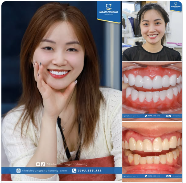 Thay sứ kim loại bằng sứ toàn phần, Đinh Hương đã có nụ cười sáng đẹp và răng miệng khỏe mạnh.