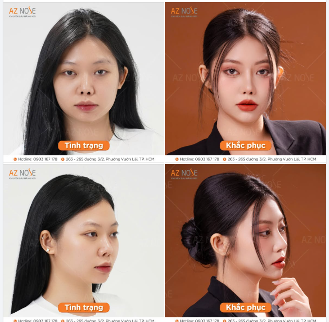 Từ chiếc mũi lệch và cánh mũi tụt đến dáng Sline cao thanh tú sau 3 tháng tái tạo mũi hỏng