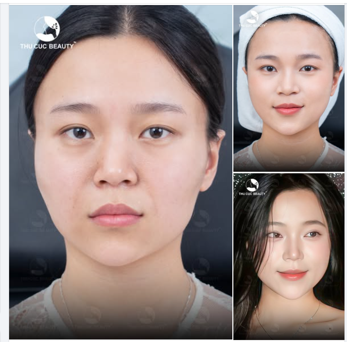 Filler TC - Gương mặt cân đối tức thì