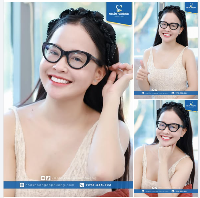 Tái khám răng sứ siêu chắc khỏe cho chị Lê Huyền