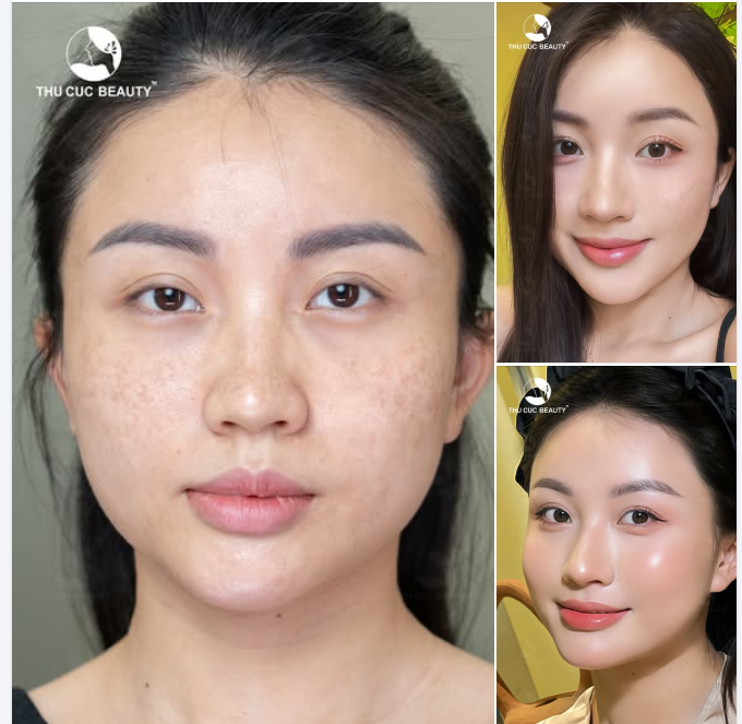 Da đẹp như mơ - Không cần "filter"  01 phác đồ trị nám tại Thu Cúc