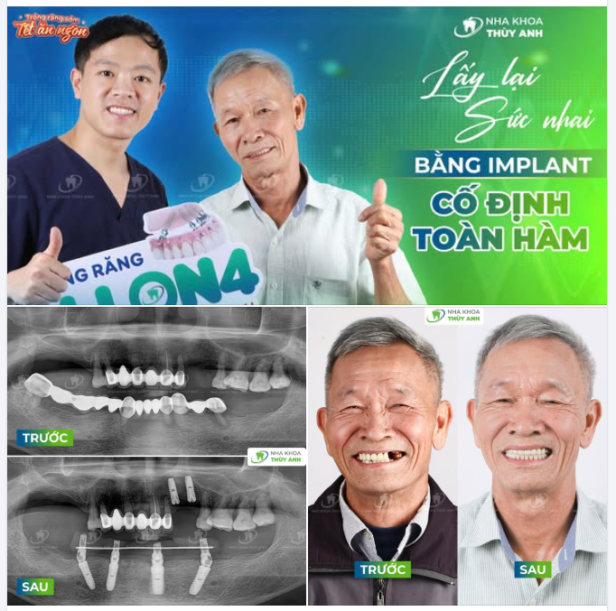 TẾT NÀY ''THOÁT KHỔ'' CẦU RĂNG HỎNG, TỰ TIN ĂN NGON VỚI HÀM RĂNG CHẮC KHỎE