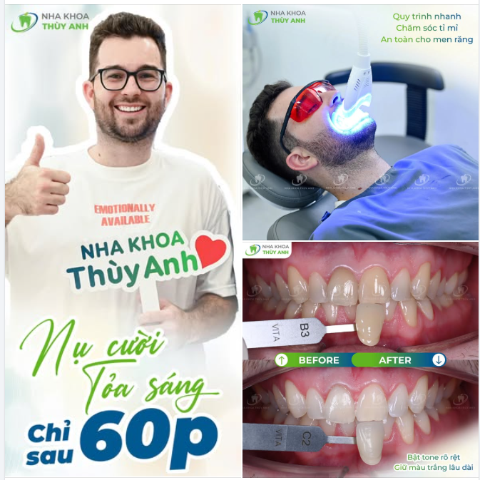 60 PHÚT BẬT TONE SÁNG BỪNG, ĐÁNH BAY RĂNG XỈN MÀU