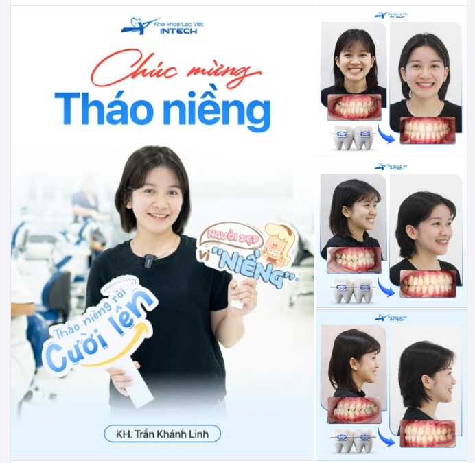 KHÔNG AI TIN CHỈ NIỀNG RĂNG MÀ THAY ĐỔI ĐƯỢC THẾ NÀY - KHÁNH LINH VÀ CÚ “LỘT XÁC” NGOẠN MỤC TUỔI 27!