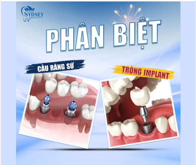 PHÂN BIỆT CẦU RĂNG SỨ VÀ TRỒNG IMPLANT