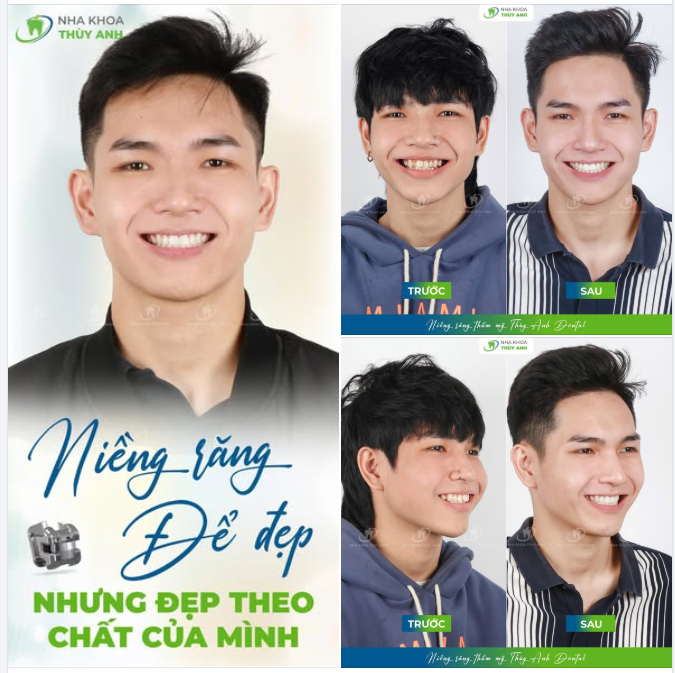 NIỀNG RĂNG ĐỔI LUÔN KHÍ CHẤT: MÀN LỘT XÁC NGOẠN MỤC CỦA DUY NAM
