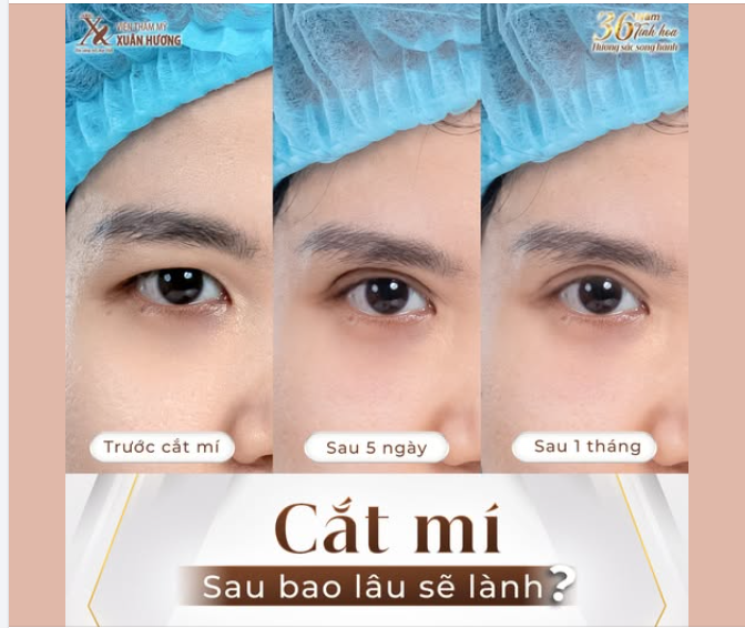 CẮT MÍ SAU BAO LÂU LÀNH ?