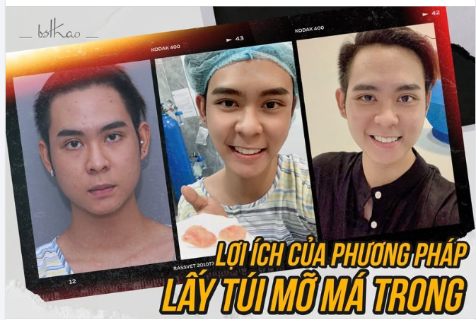 ƯU ĐIỂM CỦA PHƯƠNG PHÁP LẤY TÚI MỠ MÁ TRONG?