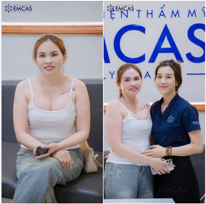 Khách tái khám sau 2 năm Nâng ngực SVF