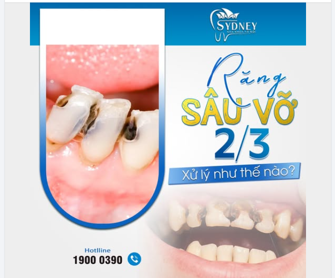 RĂNG SÂU VỠ 2/3 XỬ LÝ NHƯ THẾ NÀO?