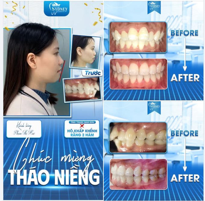 CHÚC MỪNG THÁO NIỀNG KH.PHẠM HUỆ