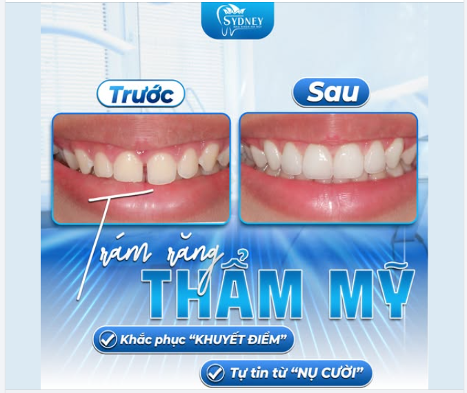 TRÁM RĂNG THẨM MỸ - KHẮC PHỤC KHUYẾT ĐIỂM, TỰ TIN TỪ NỤ CƯỜI