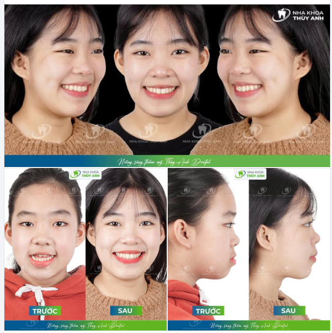 SAI LỆCH KHỚP CẮN NẶNG Ở TRẺ NHỎ: ĐIỀU TRỊ SỚM, HIỆU QUẢ BẤT NGỜ!