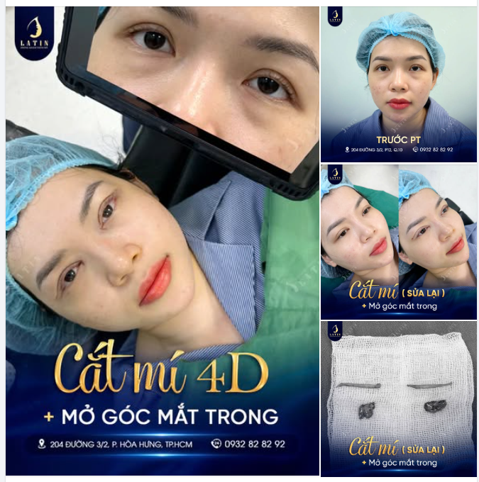SAI LẦM KHI NGHĨ RẰNG MẮT BUỒN CƠ ĐỊA LÀ KHÔNG THỂ SỬA