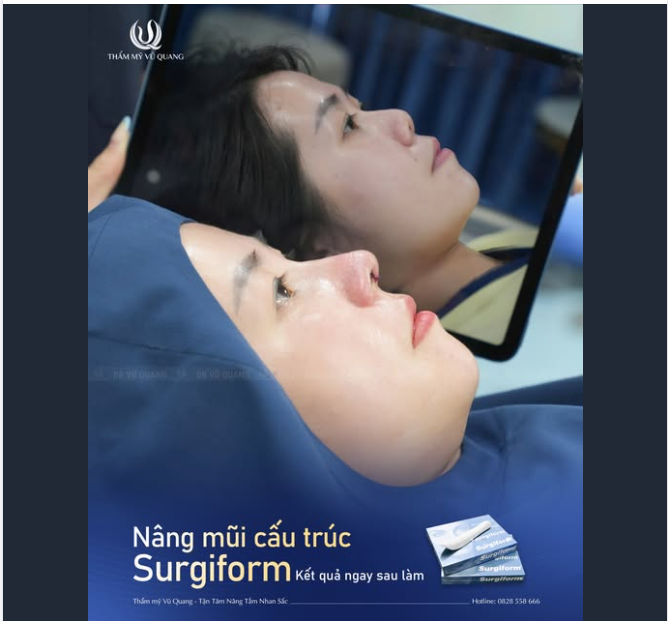 Bạn gái 9x sở hữu khuôn mặt khá tròn, baby đã được bác sĩ Vũ Quang tư vấn thiết kế dáng mũi Softline mềm mại, chất liệu sụn Surgiform chính hãng.