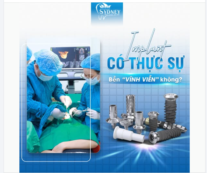 IMPLANT CÓ THỰC SỰ BỀN VĨNH VIỄN?