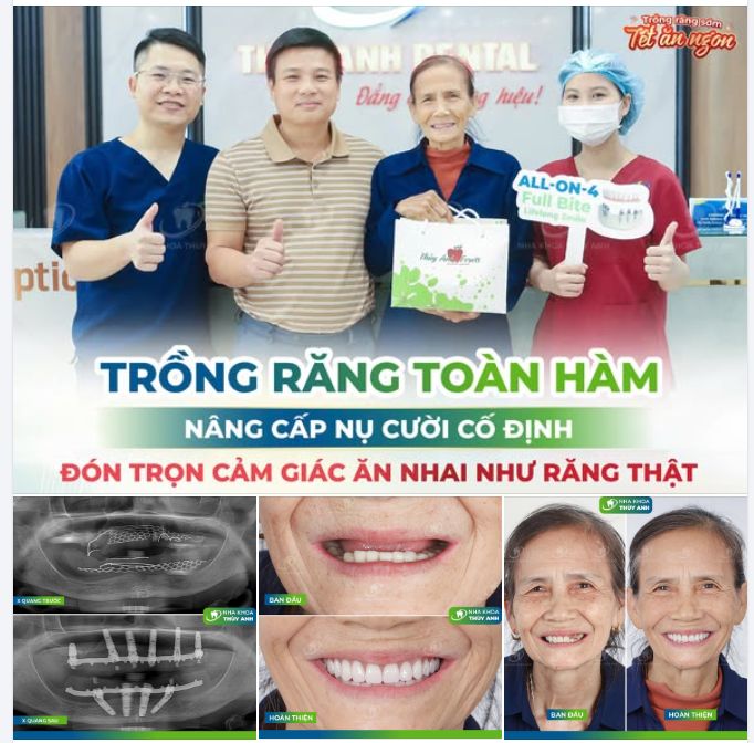 CÓ BỘ RĂNG MỚI, TẾT NÀY MẸ HẠNH PHÚC TRỌN VẸN SAU 20 NĂM ĐEO HÀM THÁO LẮP
