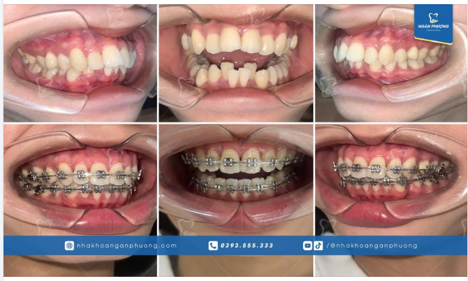 Thu đi để lại lá vàng  Niềng răng kiên nhẫn cho nàng thật xinh