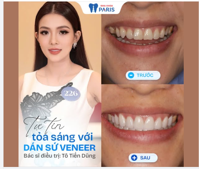 DÁN SỨ VENEER - CHẠM NHẸ NHƯNG THAY ĐỔI LỚN