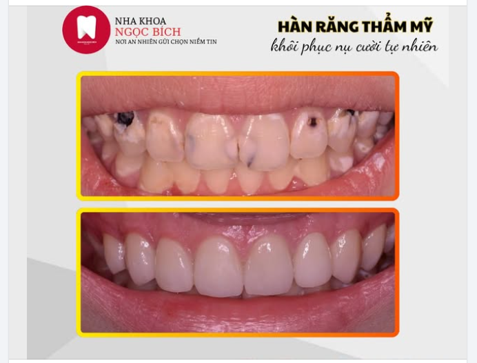 HÀN RĂNG THẨM MỸ – GIẢI PHÁP HOÀN HẢO CHO NỤ CƯỜI TỰ NHIÊN