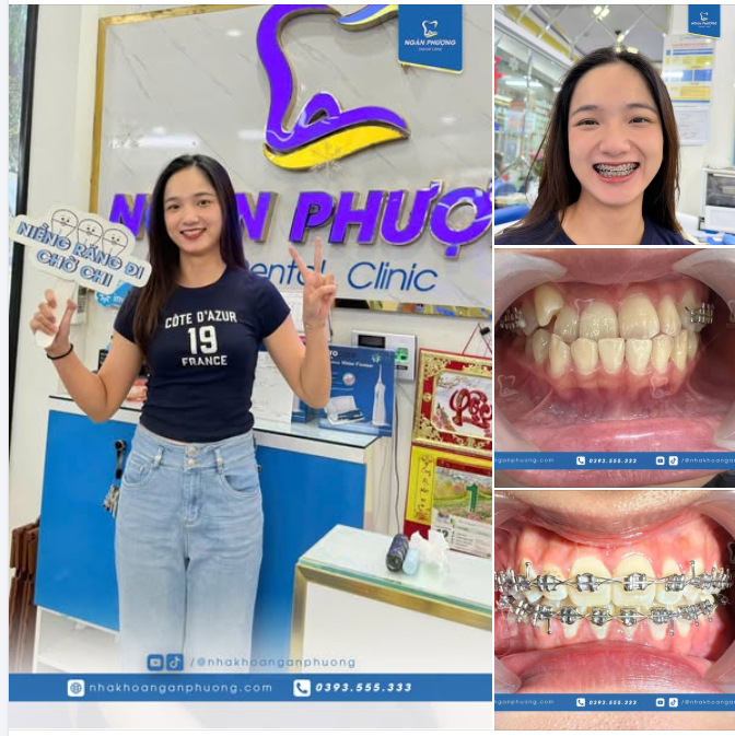 Chỉnh nha không lệch lịch nào và cái kết