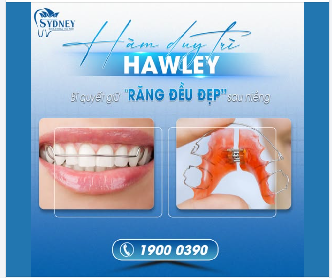 HÀM DUY TRÌ HAWLEY - BÍ QUYẾT GIỮ RĂNG ĐỀU ĐẸP SAU NIỀNG