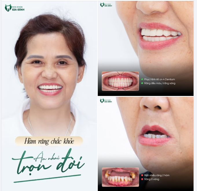 MẤT RĂNG LÂU NĂM KHIẾN DA MẶT LÃO HÓA – CÔ THỦY THAY ĐỔI HOÀN TOÀN SAU KHI CẤY GHÉP IMPLANT THÀNH CÔNG