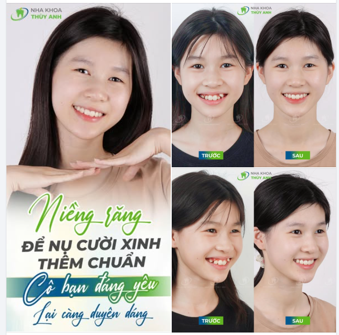 TUỔI TEEN NIỀNG RĂNG - CÀNG SỚM CÀNG TỰ TIN!