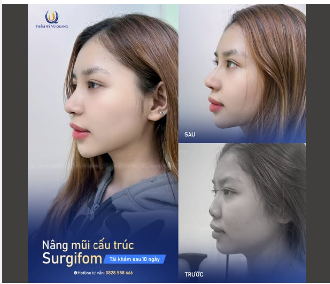 NÂNG MŨI XONG BIẾN THÀNH CON NGƯỜI KHÁC